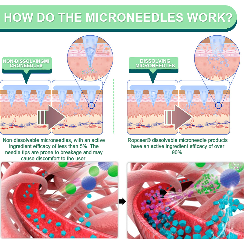【Last Day Promotion 60% OFF🔥】𝐑𝐨𝐩𝐜𝐞𝐞𝐫® NIDDK-Tirzepatide Slimming & health NANO MICRONEEDLE PATCH（Zero Pain, 24/7 Release | Lose 9 kg FAST | 90% Sugar Drop | ）